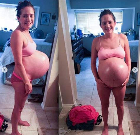 Mom Of Triplets Celebrates Stretch Marks With Powerful Post
