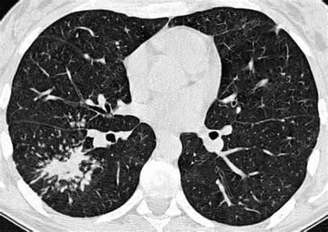 Pulmonary Sarcoidosis Ct Scan Stock Image C0146885 Science
