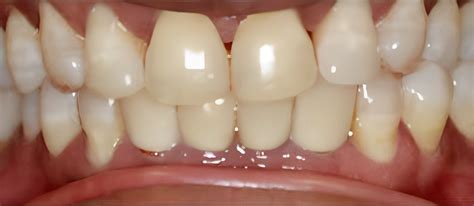 Dental Bridges For Missing Teeth In Ahwatukee Phoenix Az