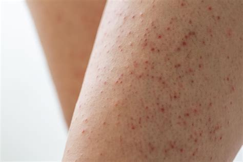Premium Photo Pillar Keratosis On A Young Womans Legs Skin Peeling