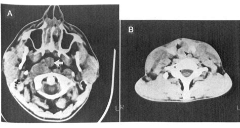 Figure 2 From Extranodal Head And Neck Sinus Histiocytosis With Massive