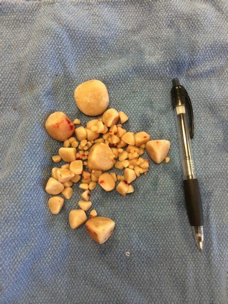 Luckily, there are natural ways to treat and prevent them. Cystotomy - Removal of bladder stones | Animal Hospital ...