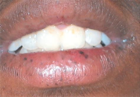 Peutz Jeghers Syndrome With Prominent Palmoplantar Pigmentation