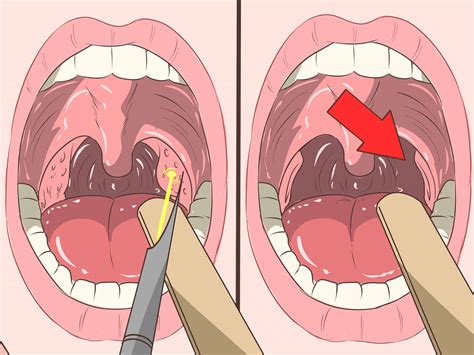 4 Ways To Remove Tonsil Stones Tonsilloliths Wikihow