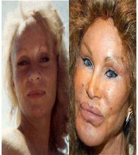 Craziest Plastic Surgery Before And After Picture