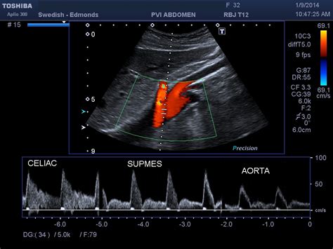 The life cycle of a pinworm is 4 to 6 weeks. Vascular Ultrasound Exams Commonly Ordered