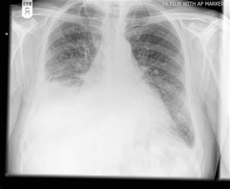An Ap View Chest Radiograph Showing Right Sided Pleural Effusion And