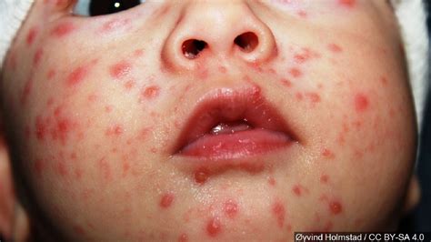 Major Chickenpox Outbreak Seen In Anti Vaccine Hot Spot