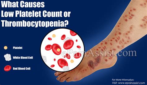 Causes Of Low Platelet Count Or Thrombocytopenia Its Effects And Ways To