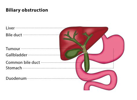 Impaired biliary excretion of tauorcholate associated with increased biliary tree permeability in mirex or chlordecone treated rats. CIRSE - Innovation | Education | Intervention