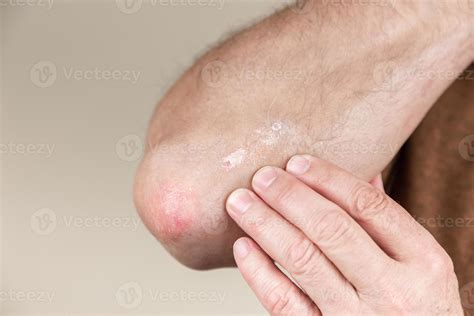 Psoriasis On The Elbow 2429326 Stock Photo At Vecteezy