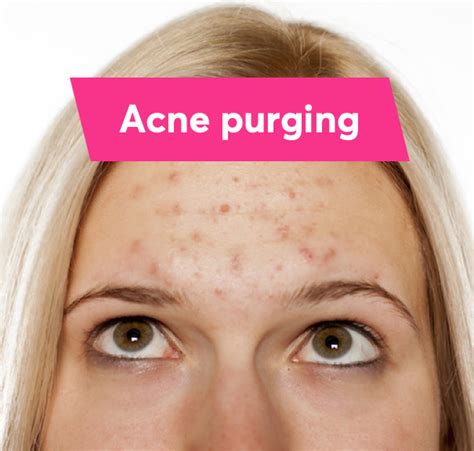 Acne Purging Full Dermatologist Guide Mdacne