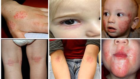 Produce inflamaciones y erupciones en la piel de color rojo vivo, además puede producir problemas respiratorios, dolor y debilidad en los músculos, cambio de color en los párpados. Alergias, asma, rinitis, dermatitis, enfermedades alérgicas.