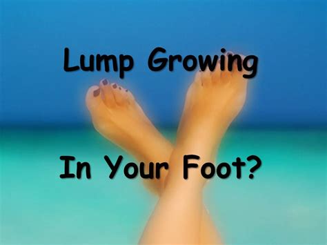 Models of foot function online course: What Do I Do If A Lump Suddenly Appears On My Foot ...