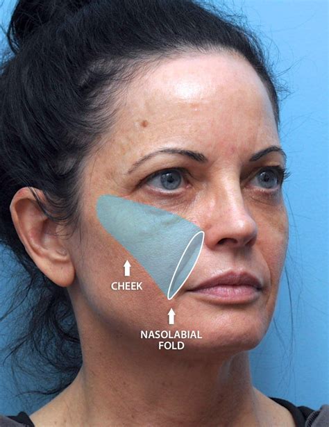 Botox For Nasolabial Folds Cosmetic Surgery Tips