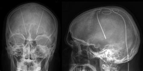 Mri Of Deep Brain Stimulation Mayo Clinic