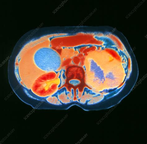 Ct Scan Showing Kidney Cancer Stock Image M1340240 Science Photo