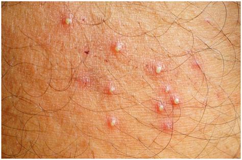 Some people confuse the small bumps and pimples with genital herpes and warts. Folliculitis vs Herpes - Symptoms, Causes, Pictures ...