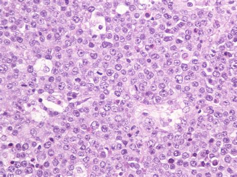 Case Of Primary Bilateral Diffuse Large B Cell Lymphoma Of The Ovary