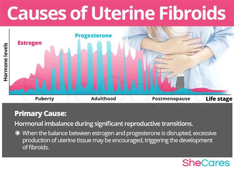 Causes Of Uterine Fibroids Hot Sex Picture