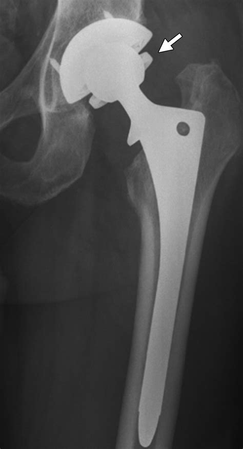 Current Concepts Of Hip Arthroplasty For Radiologists Part 2