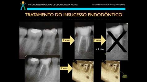 Diagn Stico E Tratamento Do Insucesso Em Endodontia Youtube