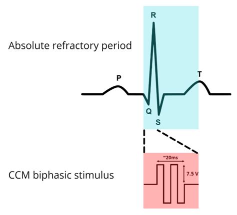 Hearts Free Full Text Cardiac Contractility Modulation In Patients