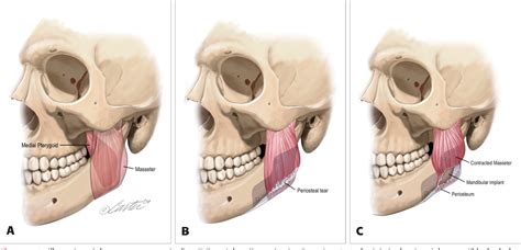 Définition du mot mandibule : Figure 1 from Masseter muscle reattachment after ...