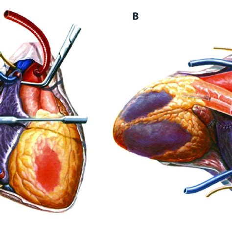 Heterotopic Thoracic Cardiac Xenotransplantation With The Recipient