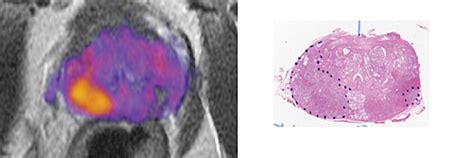 Imaging Biomarker Distinguishes Prostate Cancer Tumor Grade