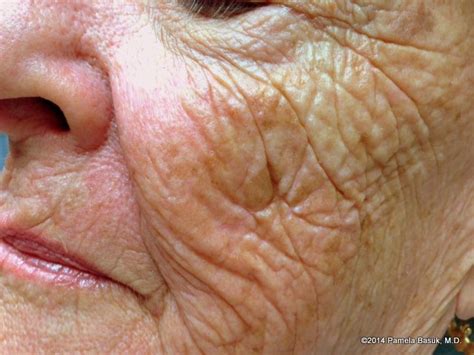Aging Skin Basuk Dermatology