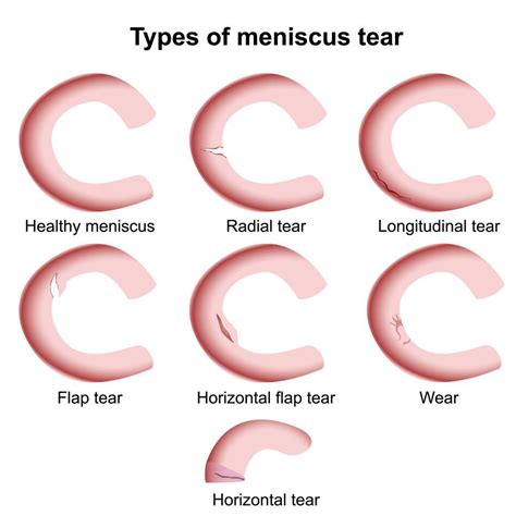 Summary Of Isakos Classification Of Meniscal Tears Description My Xxx