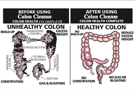 kolonics benefits colon hydrotherapy weight loss and intestinal cleanse