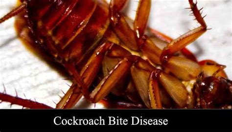 Cockroach Bite Disease Atopic Dermatitis Gavoot