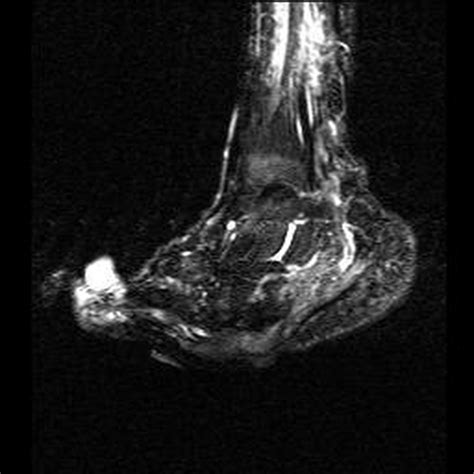 Er tritt vor allem im rahmen einer diabetischen neuropathischen osteoarthropathie (dnoap) auf. COX DB