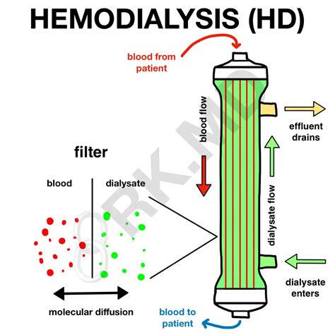 Renal Replacement Therapy Hemodialysis And Hemofiltration Rk Md