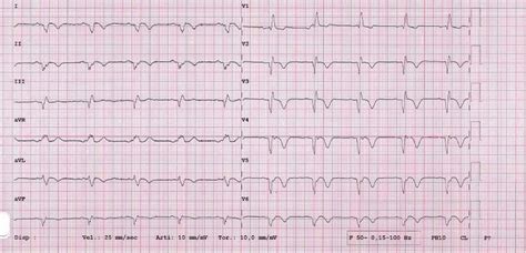 12 Lead Ecg St Segment Elevation And Q Waves In The Infero Lateral