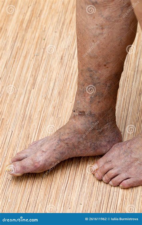 Cropped Senior Woman Bare Legs And Feet With Painful Protruding Spider Varicose Veins