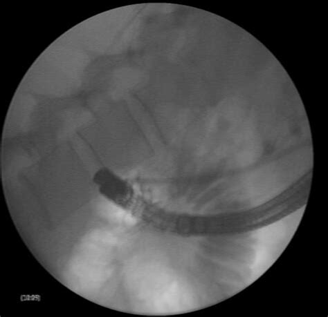 In The Ercp Procedure Cholangiogram Shows A Bile Fistula From The