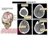 AMICUS Illustration Of Amicus Injury Brain CT Skull Comminuted Fracture
