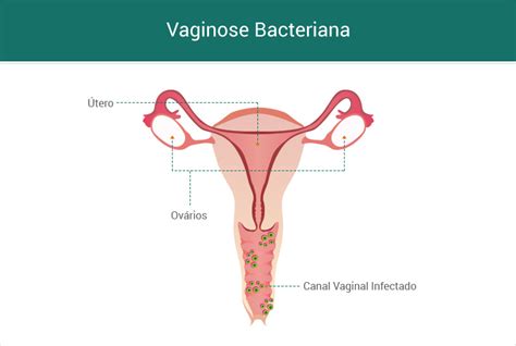 Vaginose Bacteriana Causas Sintomas E Tratamento Doc