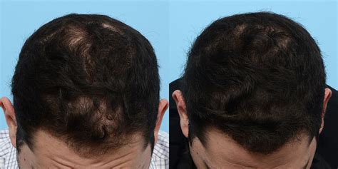 Hair Restoration Before And After Dr Jeffrey Wise