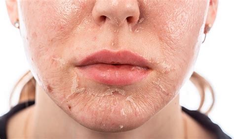 How To Treat A Chemical Burn On Face From Skincare