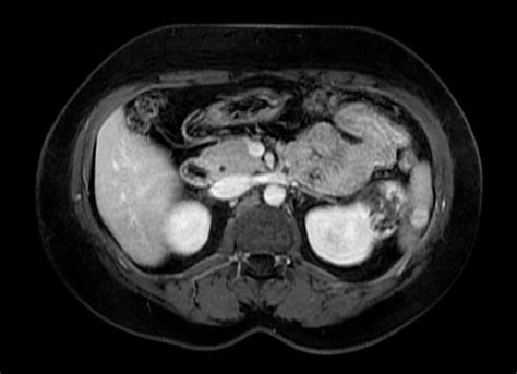 Cystic Renal Cell Carcinoma Body Mr Case Studies Ctisus Ct Scanning