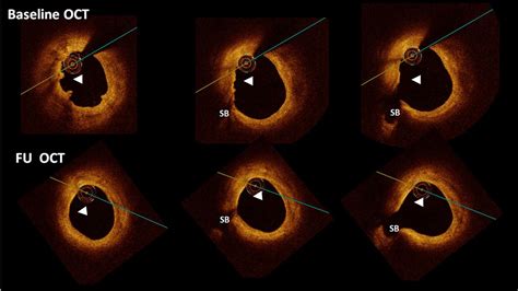 Oct And Ffr Dr Tejas V Patel Cardiologist In Ahmedabad