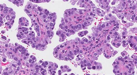Clear Cell Carcinoma Of The Uterus Atlas Of Pathology