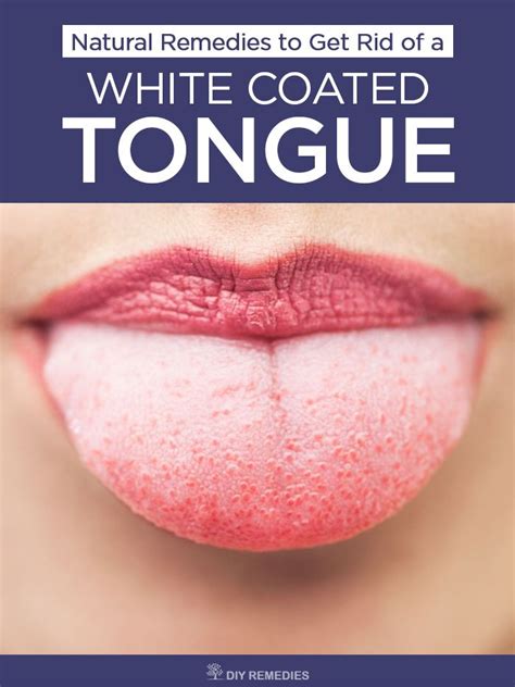 Natural Remedies To Get Rid Of A White Coated Tongue It Is Not A