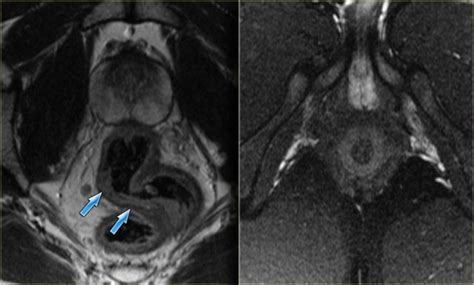 The Radiology Assistant Perianal Fistulas