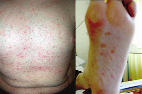 A Maculopapular Rash On The Abdomen And Soles—characteristic Of