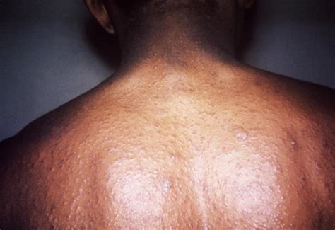 What Is Pityriasis Rosea Thailand Medical News